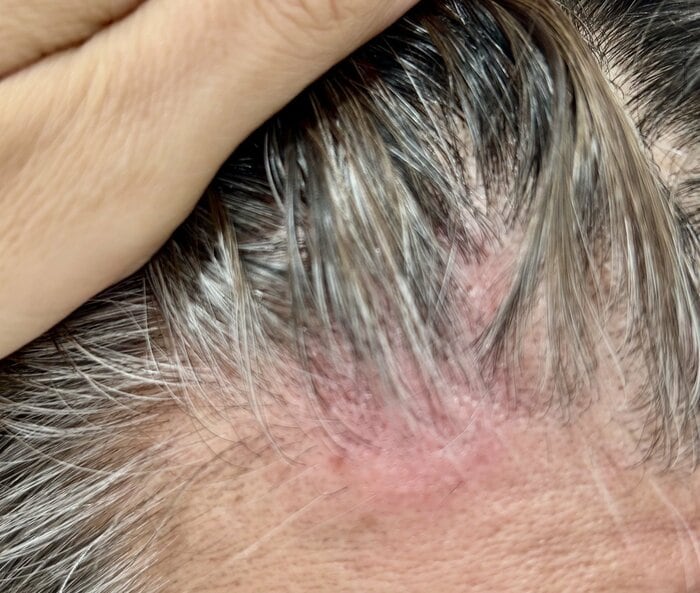 火傷のように赤く荒れた頭皮（提供：一般社団法人 国際毛髪皮膚科学研究所）