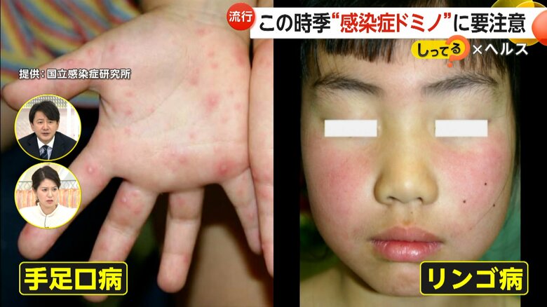 手足口病と東京都などで警報レベルとなっているリンゴ病の症状