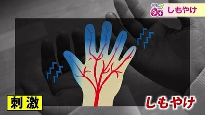 手袋や耳当てで予防　「しもやけ」は温度変化に注意　難病が潜むケースも【福井発】