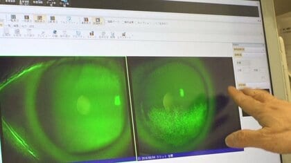 【注意】紫外線だけじゃない！？熱中症で「白内障」のリスク増加　夏の“目のダメージ”を防ぐためには？