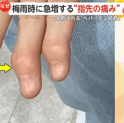 【なぜ？】梅雨時に急増する“指先の痛み”　関節腫れる「へバーデン結節」…国内で約300万人　“スマホの触りすぎ”にも注意