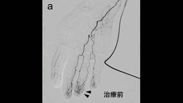 「動注治療」前の異常な血管が見られる指(提供:オクノクリニック銀座)