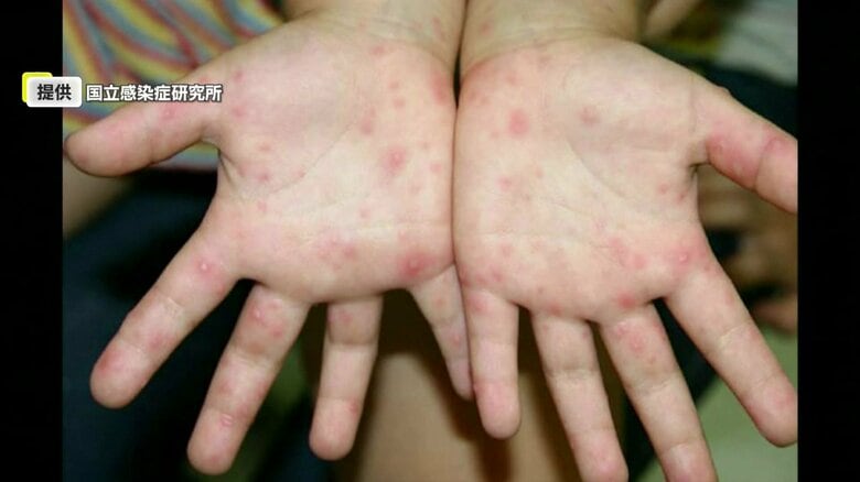 手足口病の感染者が1週間で131人に急増　長崎、佐世保、県北地区では警報レベルに｜FNNプライムオンライン