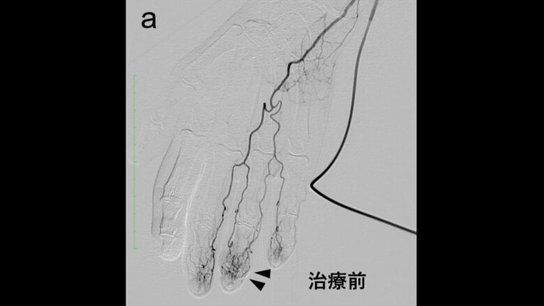「動注治療」前の異常な血管が見られる指（提供：オクノクリニック銀座）