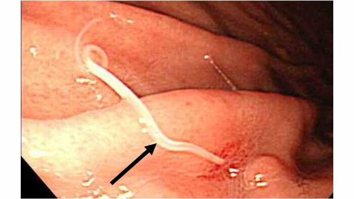 胃の粘膜に潜入するアニサキスの幼虫(画像提供:国立感染症研究所)