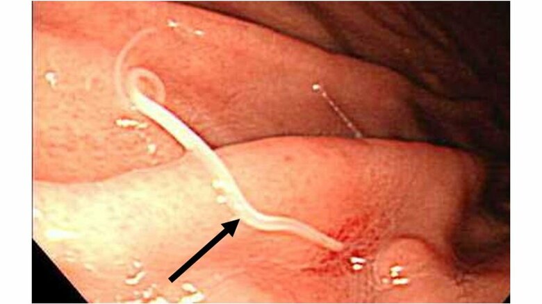 粘膜にもぐり込み穴が空くことも！？胃や腸に激痛が走るアニサキス症…疑いがあったらどうすればいいのか聞いた｜FNNプライムオンライン
