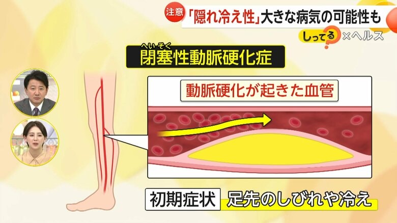 冷えの原因となる閉塞性動脈硬化症
