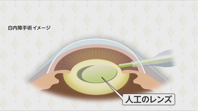 白内障手術のイメージ（人工のレンズを入れる）
