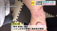 季節外れの流行 手足口病の患者さらに増加 大分