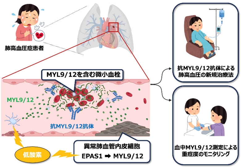 難治性疾患「肺高血圧症」の新たな治療標的を同定～血管構造の悪化を引き起こすタンパク質「MYL9/12」～