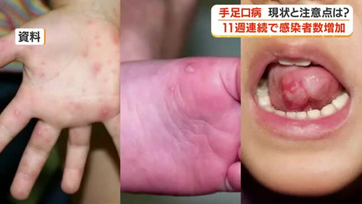 【医療機関に聞く】手足口病 現状と注意点は? 11週連続で感染者数増加