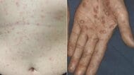 キスなどで感染することも…性感染症『梅毒』の感染者が急増中 医師「不特定多数の人と性交しないのが一番」