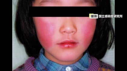 「リンゴ病」9週連続で警報レベル　1週間の患者数は94人　手洗いやマスクの着用で感染予防を呼び掛け