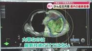 がん検診 放射線をピンポイント当て腫瘍を消失　最新医療機器の導入進む 早期発見・治療を　大分