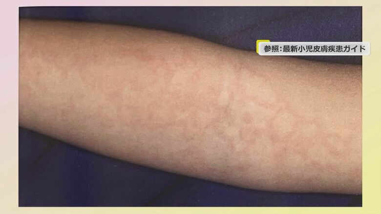 リンゴ病患者にみられる症状