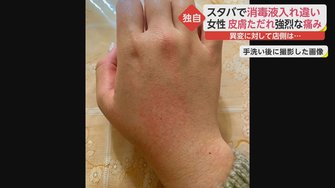 独自 スタバ店頭の消毒液で皮膚のただれと痛み 原因はまさかの 詰め替えミス 被害女性はトラウマに