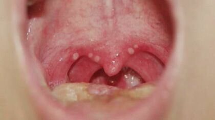 コロナ対策緩和と免疫力低下も影響か…子供中心に飛沫等で感染「ヘルパンギーナ」三重で警報レベル超えて拡大【三重発】