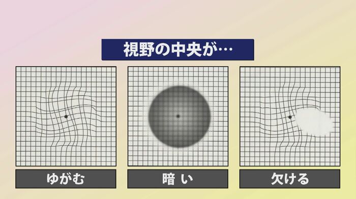 加齢黄斑変性の症状