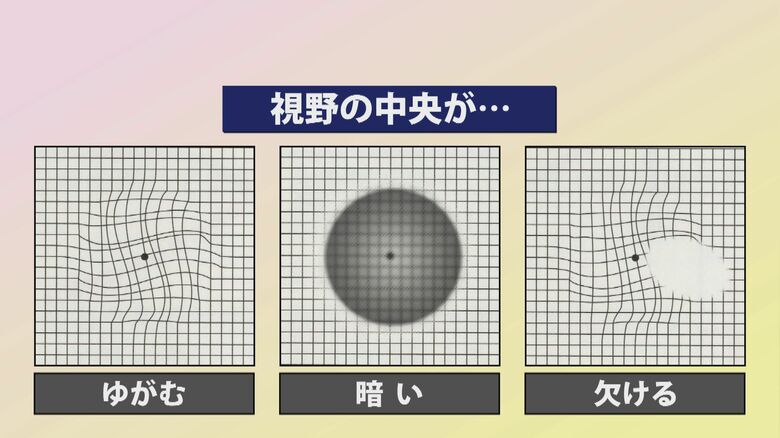 加齢黄斑変性の症状