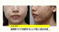 マスク生活の肌トラブル「マスクネ」とは？医師が勧めるニキビ・湿疹予防のスキンケアとマスク選び