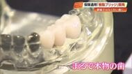 銀歯から白い歯へ「YAMAKIN」国内初開発の《樹脂ブリッジ》が保険適用、治療費は3割減