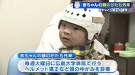 「赤ちゃんの頭の形が気になる」 ヘルメットで矯正の外来に受診者急増 生後6か月までに始めると効果的 広島大学病院