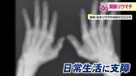 発症後2年で急激に悪化「関節破壊」で日常生活にも支障をきたす「関節リウマチ」“何かおかしい”違和感あれば受診を