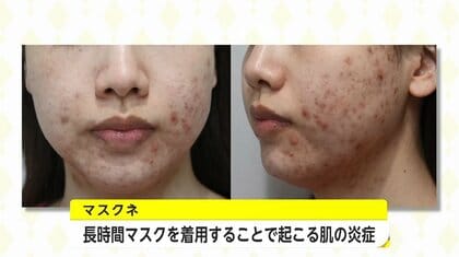 マスク生活の肌トラブル「マスクネ」とは？医師が勧めるニキビ・湿疹予防のスキンケアとマスク選び
