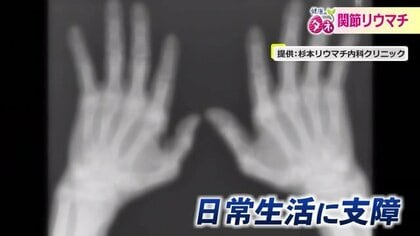 発症後2年で急激に悪化「関節破壊」で日常生活にも支障をきたす「関節リウマチ」“何かおかしい”違和感あれば受診を