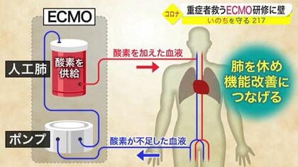 新型コロナ重症者救う！人工心肺装置「ECMO」最新医療が進まぬ壁