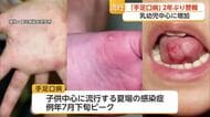 手足口病が急増…県が2年ぶり警報　患者数が流行基準超える【佐賀県】