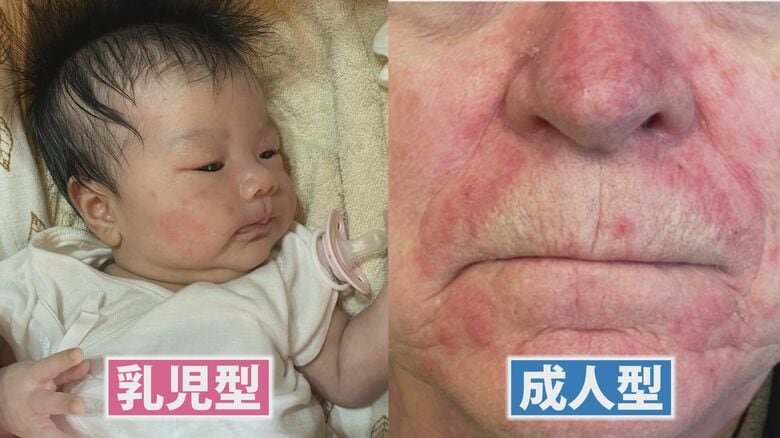乳幼児型と成人型がある脂漏性皮膚炎