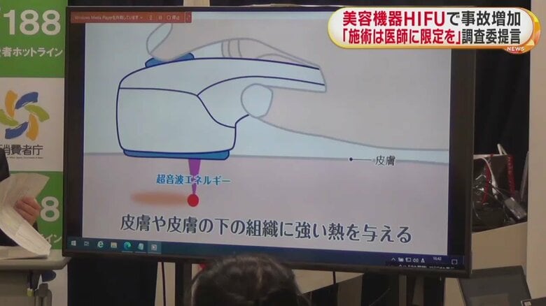 「HIFU」について説明するVTR