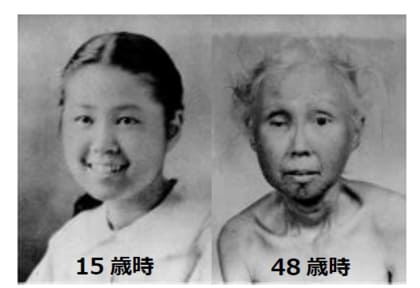 世界初!早老症ウェルナー症候群患者さんを対象とする臨床試験~ニコチンアミド リボシドが動脈硬化指標、難治性潰瘍、腎機能改善に有効