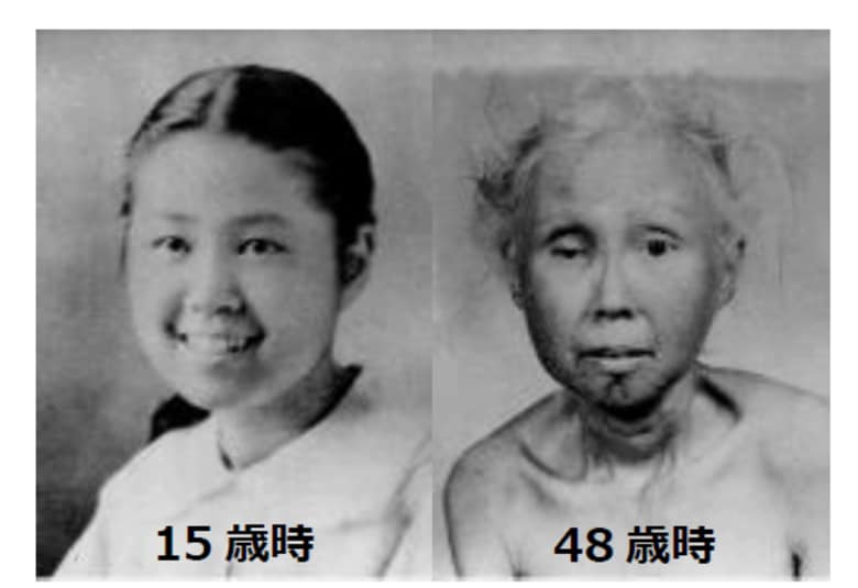世界初!早老症ウェルナー症候群患者さんを対象とする臨床試験~ニコチンアミド リボシドが動脈硬化指標、難治性潰瘍、腎機能改善に有効