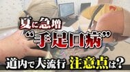【専門家が解説】『症状が治まっても便から数週間ウイルスが排出』“手足口病”が北海道で大流行…札幌市で4週連続”警報レベル”超え―感染防ぐ3つのポイントとは