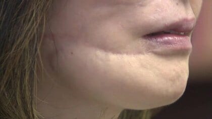 「私の顔を、時間を返して…」一瞬で一生が変わった福島・飲食店爆発事故　巻き込まれた女性の凄絶体験