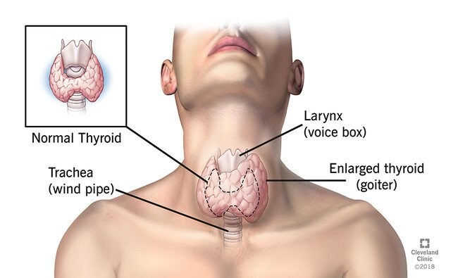 Thyroid Cancer Diagnosis Thyroid Cancer Diagnosis