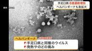 宮城県内で「手足口病」患者が８週連続増加　「ヘルパンギーナ」も急拡大で感染対策徹底を呼びかけ