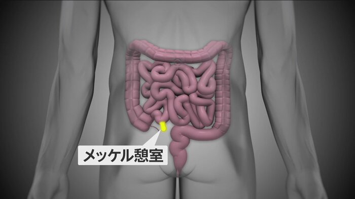 メッケル憩室は小腸の出口付近にできた袋状の突起物