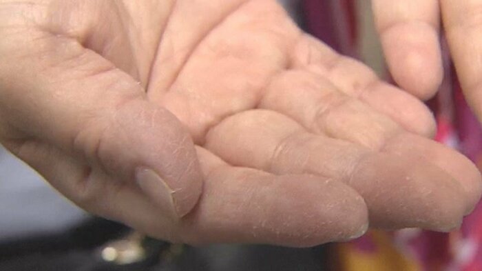 街頭インタビューより「主婦湿疹」に悩む人が見せてくれた手荒れ