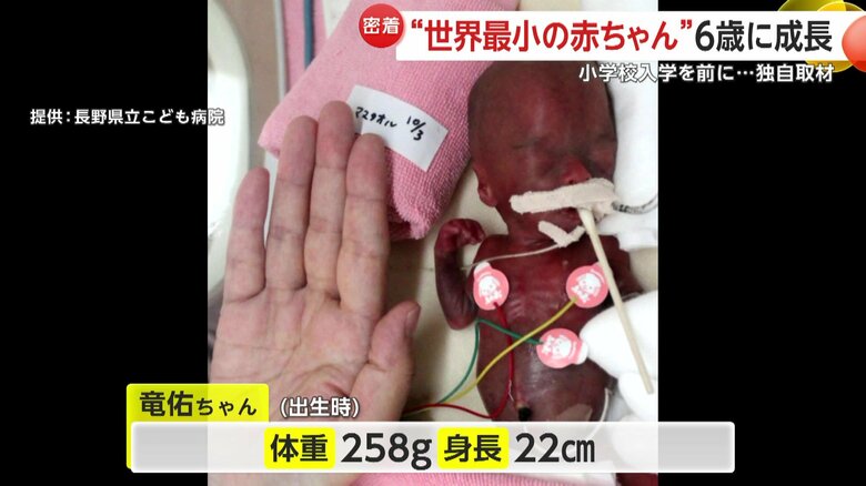 出生時、竜佑ちゃんの体重はわずか258グラム、身長22センチの「低出生体重児」だった