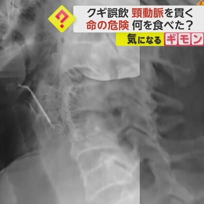 「てっきり骨だろうと」喉から約5cmの釘を摘出　誤飲して頸動脈を貫通…その状態で1カ月過ごすも無事退院　ペルー