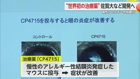 世界初“分子治療薬”開発へ 慢性のアレルギー性結膜炎の原因解明に取り組む【佐賀県】