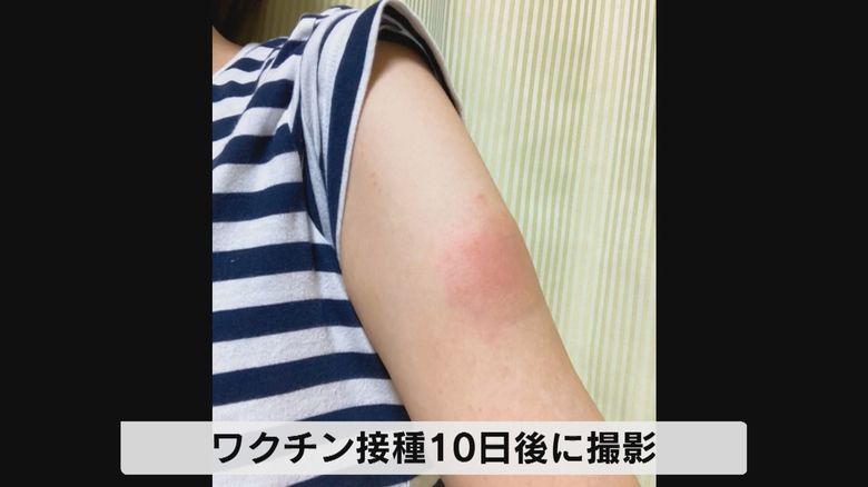 ワクチン接種10日後、二の腕が赤くなっている