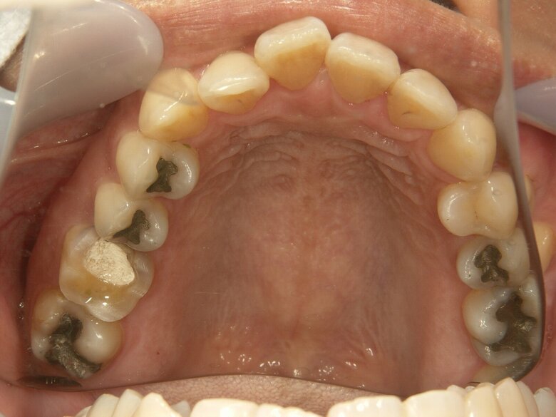 黒っぽい詰め物は全てアマルガム（提供：アンチエイジングデンタルクリニック恵比寿）