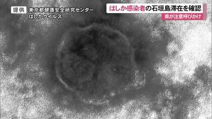 県がはしか感染に注意喚起　県外の男性がり患判明　石垣市内に滞在