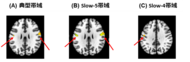 社交不安症患者の脳活動に新発見～感覚処理領域の活動低下が認知機能障害と関連～