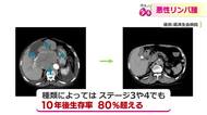 臓器で発生すると初期症状なし…悪性リンパ腫　“しこり”や発熱、気になる症状に応じた受診を　進行していても「治癒や長期生存が見込める」　