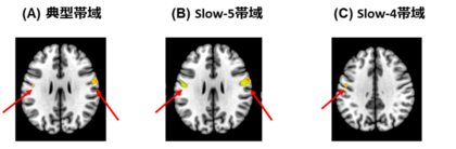 社交不安症患者の脳活動に新発見～感覚処理領域の活動低下が認知機能障害と関連～